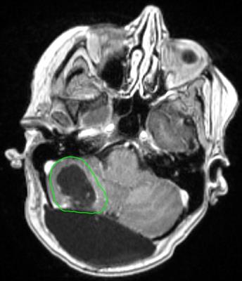 Preoperative stereotactic radiosurgery in the management of brain metastases and gliomas